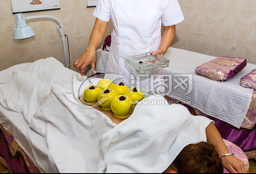 拔火罐.jpg